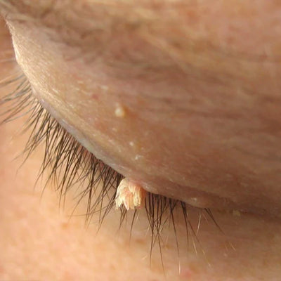 Acrocordón filiforme